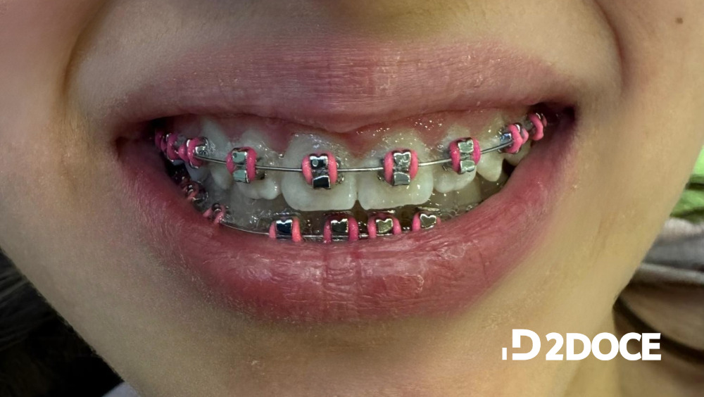 urgencias-ortodoncia Una paciente de ortodoncia con una urgencia derivada del tratamiento.