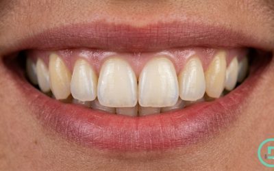 Colmillos más amarillos: causas, aclaración y blanqueamiento dental en Madrid