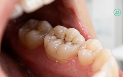 Manchas negras en las muelas: ¿son caries?
