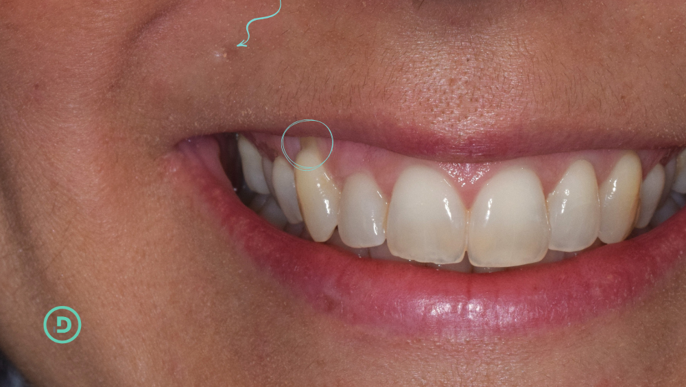 Paciente con recesión de encías debido al uso de piercing en el labio superior.