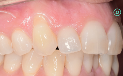 Piercing labial y encías: lo que no siempre te cuentan