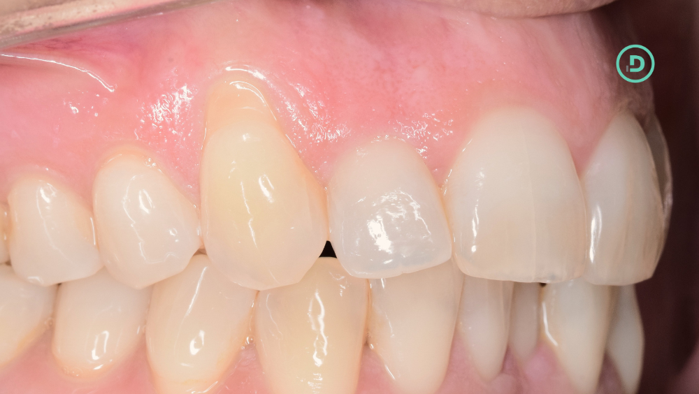Paciente con recesión dental debido al uso de piercing labial prolongado.